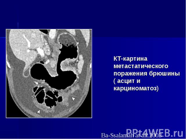 КТ-картина метастатического поражения брюшины ( асцит и карциноматоз)