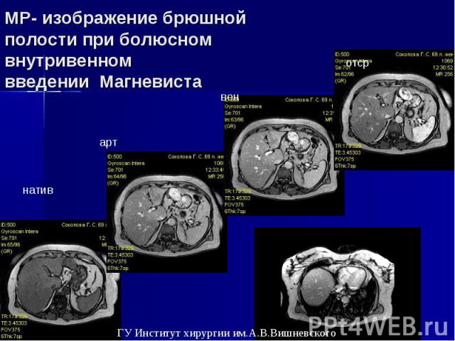 МР- изображение брюшной полости при болюсном внутривенном введении Магневиста