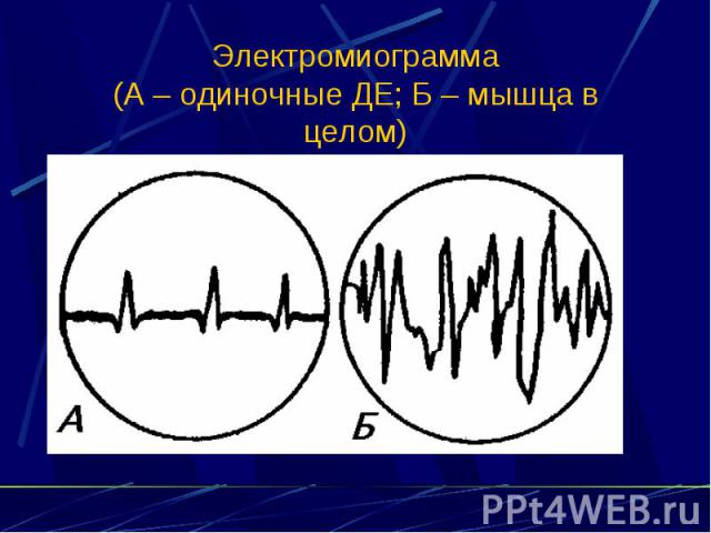 Электромиограмма (А – одиночные ДЕ; Б – мышца в целом)