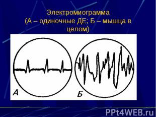 Электромиограмма (А – одиночные ДЕ; Б – мышца в целом)