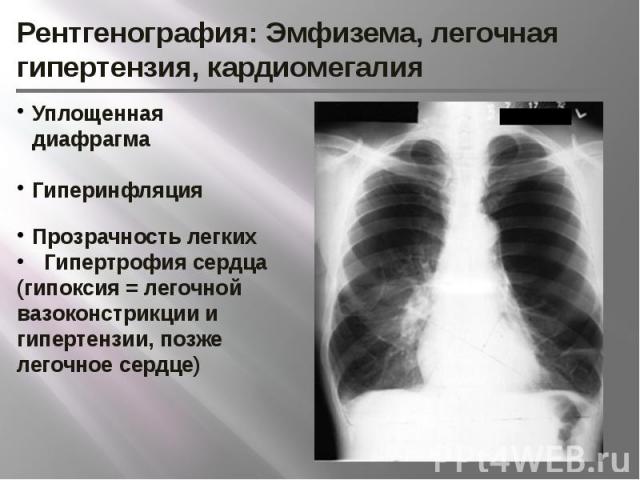 Рентгенография: Эмфизема, легочная гипертензия, кардиомегалия