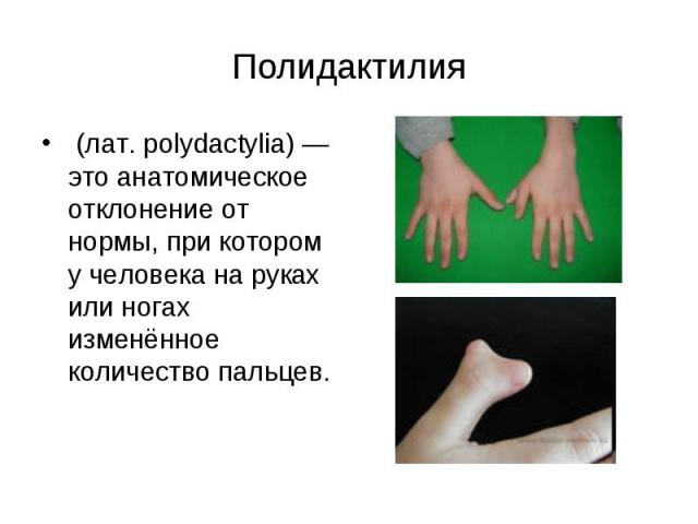 Полидактилия (лат. polydactylia) — это анатомическое отклонение от нормы, при котором у человека на руках или ногах изменённое количество пальцев.