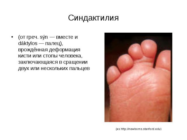 Синдактилия (от греч. sýn — вместе и dáktylos — палец), врождённая деформация кисти или стопы человека, заключающаяся в сращении двух или нескольких пальцев