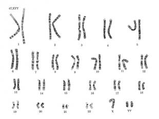 Синдром дисомии по y хромосоме презентация