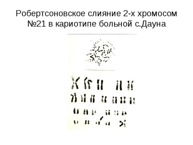 Робертсоновское слияние 2-х хромосом №21 в кариотипе больной с.Дауна