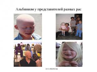 Альбинизм у представителей разных рас