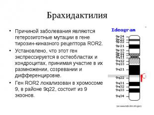 Брахидактилия Причиной заболевания являются гетерозиготные мутации в гене тирози