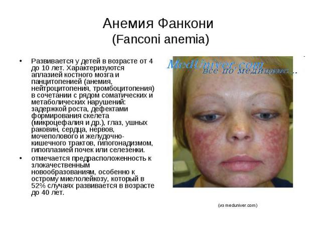 Анемия Фанкони (Fanconi anemia) Развивается у детей в возрасте от 4 до 10 лет. Характеризуются аплазией костного мозга и панцитопенией (анемия, нейтроцитопения, тромбоцитопения) в сочетании с рядом соматических и метаболических нарушений: задержкой …