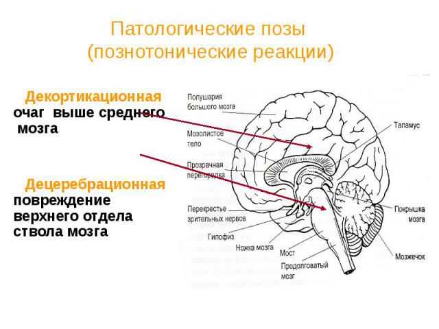 Патологические позы (познотонические реакции) Декортикационная очаг выше среднего мозга Децеребрационная повреждение верхнего отдела ствола мозга