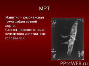 Манитно – резонансная Манитно – резонансная томография ветвей аорты. Стеноз чрев