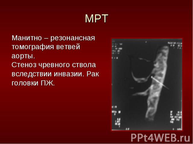 Манитно – резонансная Манитно – резонансная томография ветвей аорты. Стеноз чревного ствола вследствии инвазии. Рак головки ПЖ.