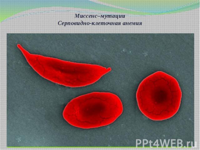Миссенс–мутации Серповидно-клеточная анемия Замена всего лишь одного нуклеотида и одной аминокислоты приводит к развитию такого заболевания как серповидноклеточная анемия.