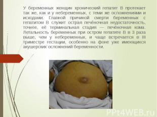 У беременных женщин хронический гепатит B протекает так же, как и у небеременных