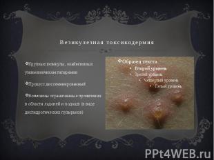 Везикулезная токсикодермия Крупные везикулы, окаймленных узким венчиком гипереми