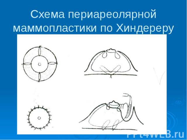 Схема периареолярной маммопластики по Хиндереру