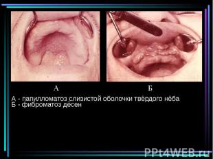 А - папилломатоз слизистой оболочки твёрдого нёба Б - фиброматоз дёсен