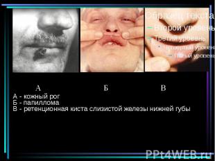 А - кожный рог Б - папиллома В - ретенционная киста слизистой железы нижней губы
