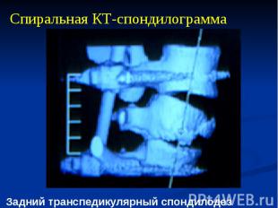 Спиральная КТ-спондилограмма Задний транспедикулярный спондилодез