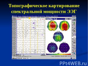 Топографическое картирование спектральной мощности ЭЭГ