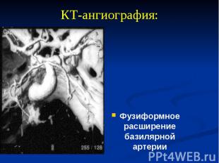 КТ-ангиография: Фузиформное расширение базилярной артерии