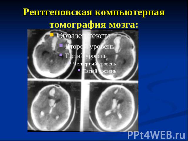 Рентгеновская компьютерная томография мозга: