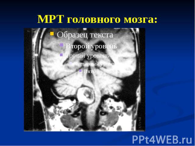 МРТ головного мозга: