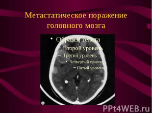 Метастатическое поражение головного мозга