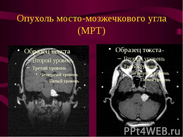 Опухоль мосто-мозжечкового угла (МРТ)