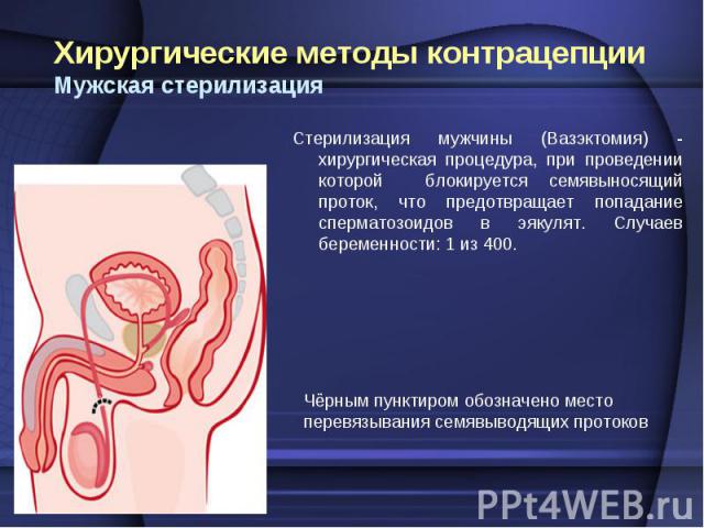 Стерилизация мужчины (Вазэктомия) - хирургическая процедура, при проведении которой блокируется семявыносящий проток, что предотвращает попадание сперматозоидов в эякулят. Случаев беременности: 1 из 400. Стерилизация мужчины (Вазэктомия) - хирургиче…