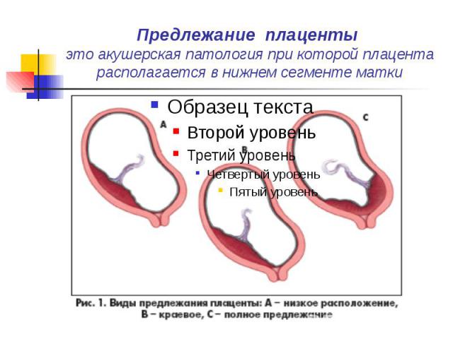 Предлежание плаценты это акушерская патология при которой плацента располагается в нижнем сегменте матки