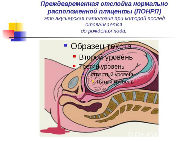 Преждевременная отслойка нормально расположенной плаценты (ПОНРП) это акушерская патология при которой послед отслаивается до рождения пода.