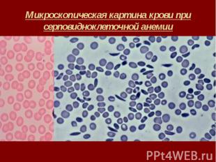Микроскопическая картина крови при серповидноклеточной анемии