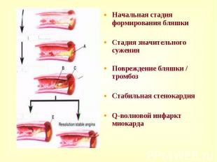 Начальная стадия формирования бляшки Начальная стадия формирования бляшки Стадия