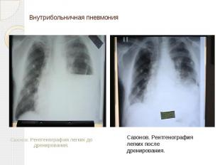 Внутрибольничная пневмония Сазонов. Рентгенография легких до дренирования.