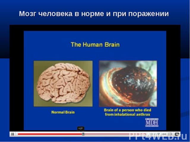 Мозг человека в норме и при поражении