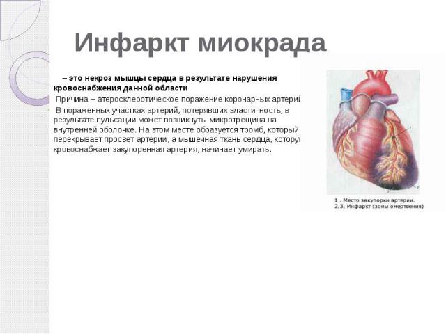 Инфаркт миокрада – это некроз мышцы сердца в результате нарушения кровоснабжения данной области Причина – атеросклеротическое поражение коронарных артерий. В пораженных участках артерий, потерявших эластичность, в результате пульсации может возникну…