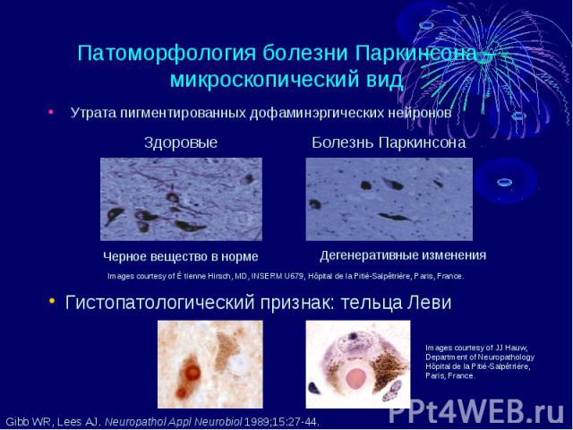 Патоморфология болезни Паркинсона – микроскопический вид Утрата пигментированных дофаминэргических нейронов