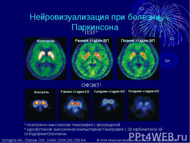 Нейровизуализация при болезни Паркинсона