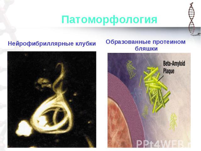 Нейрофибриллярные клубки Нейрофибриллярные клубки