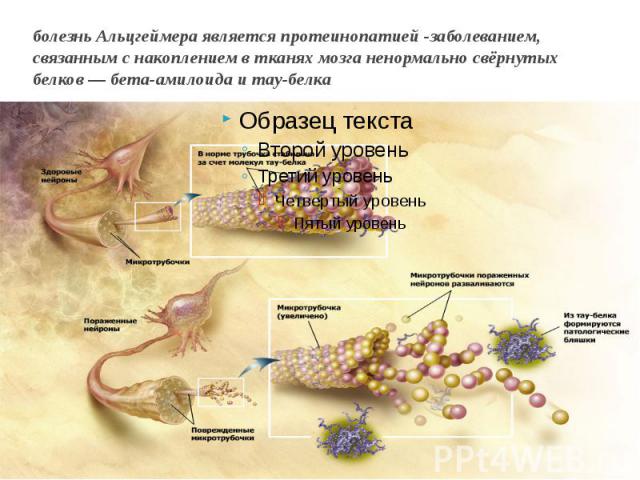 болезнь Альцгеймера является протеинопатией -заболеванием, связанным с накоплением в тканях мозга ненормально свёрнутых белков — бета-амилоида и тау-белка
