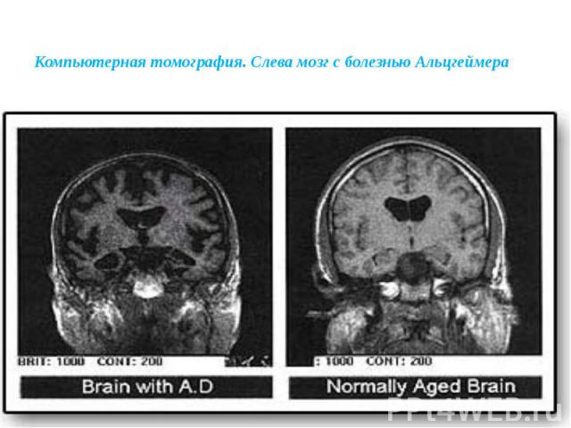 Компьютерная томография. Слева мозг с болезнью Альцгеймера