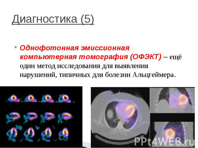 Диагностика (5) Однофотонная эмиссионная компьютерная томография (ОФЭКТ) – ещё один метод исследования для выявления нарушений, типичных для болезни Альцгеймера.