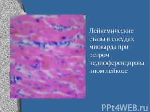 Лейкемические стазы в сосудах миокарда при остром недифференцированном лейкозе Л