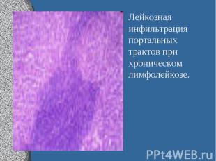 Лейкозная инфильтрация портальных трактов при хроническом лимфолейкозе. Лейкозна