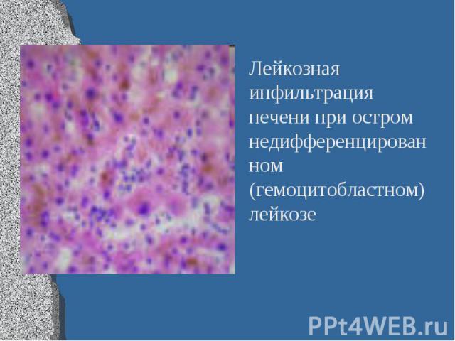 Лейкозная инфильтрация печени при остром недифференцированном (гемоцитобластном) лейкозе Лейкозная инфильтрация печени при остром недифференцированном (гемоцитобластном) лейкозе