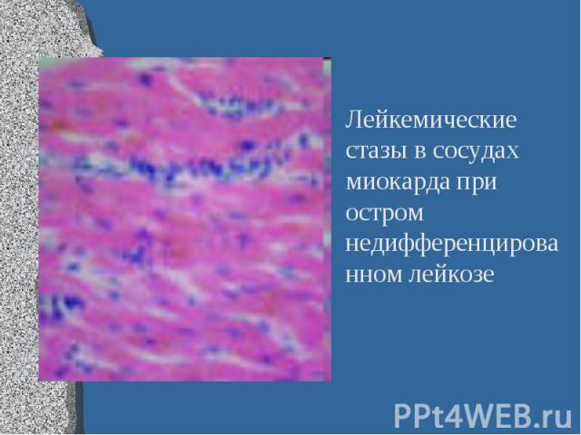 Лейкемические стазы в сосудах миокарда при остром недифференцированном лейкозе Лейкемические стазы в сосудах миокарда при остром недифференцированном лейкозе