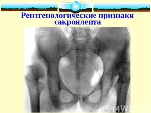 Рентгенологические признаки сакроилеита