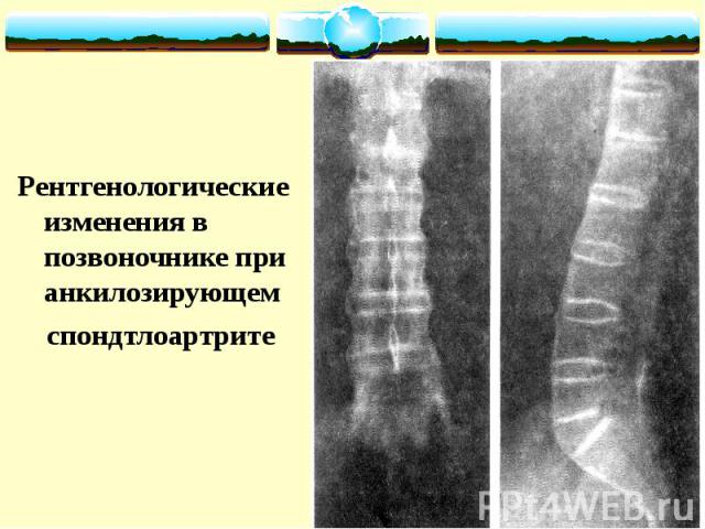Рентгенологические изменения в позвоночнике при анкилозирующем спондтлоартрите