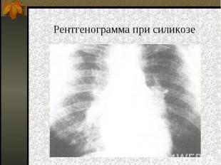 Рентгенограмма при силикозе