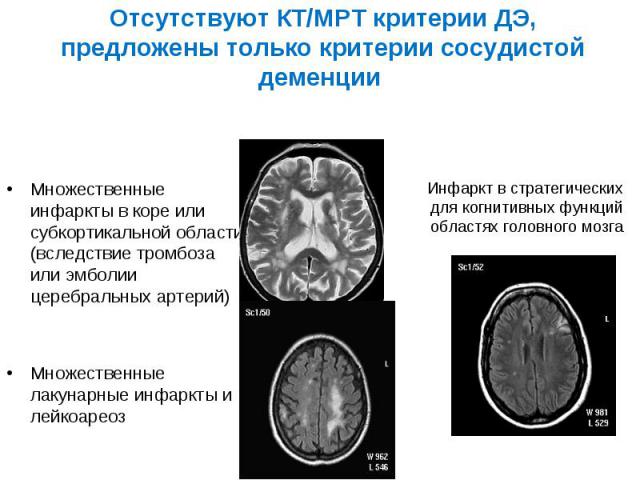 Лакунарная деменция. Лейкоареоз на кт. Лейкоареоз головного мозга на кт. Лейкоареоз мрт. Множественные лакунарные инфаркты мрт.